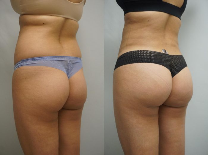 Brazilian Butt Lift Surgery Before and After