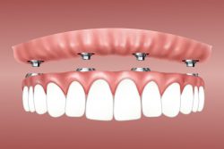 Affordable Dental Implant Specialist in Houston