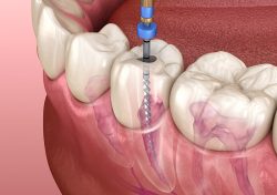 Root Canal Treatment in Aventura