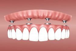 How Long Is the Dental Implant Surgery Recovery?