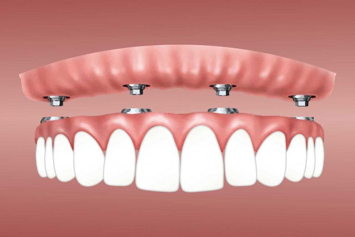 How Long Is the Dental Implant Surgery Recovery?