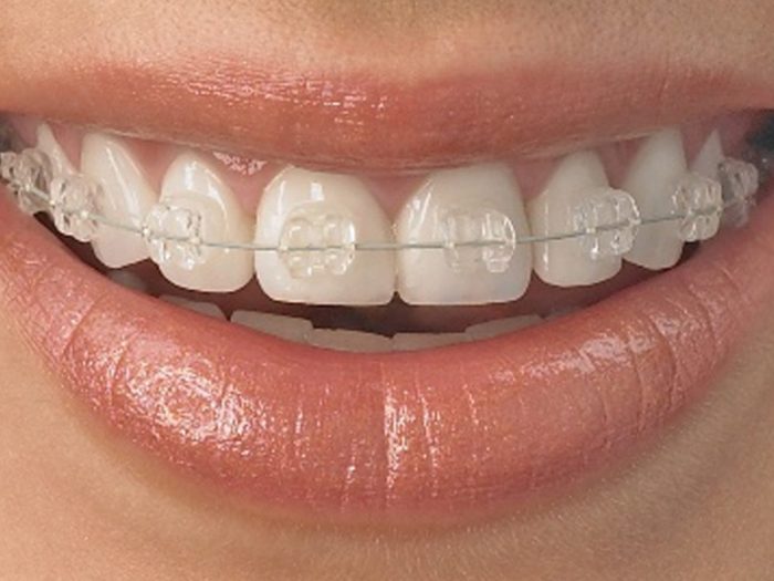 Orthodontic Treatment Options For Adults