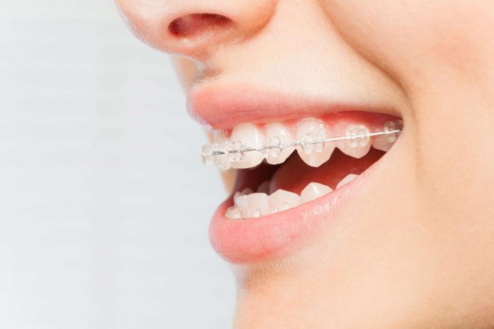 Orthodontic Treatment Options For Adults