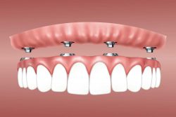 Dental Implant Procedure – Edge Dental