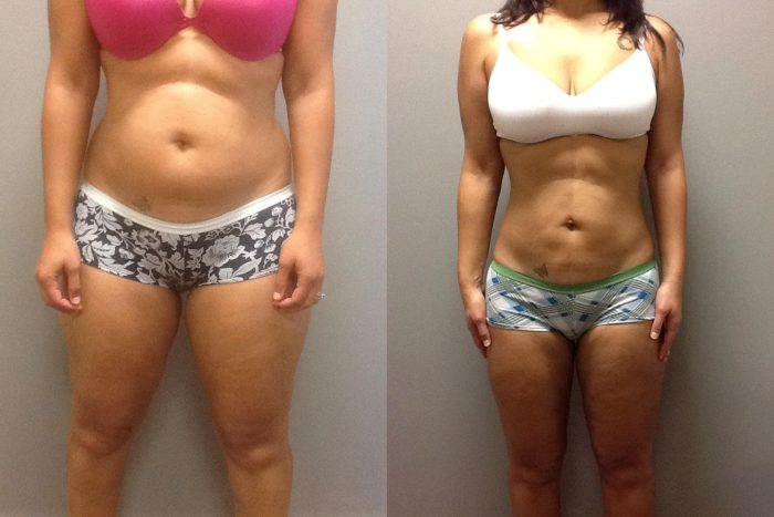 Liposuction Results Before And After