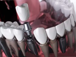 Dental Implant Specialist in Houston, TX