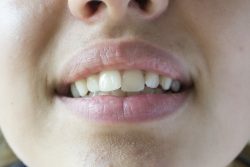 Veneers On Crooked Teeth