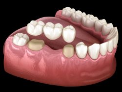 What are Dental Crowns and Tooth Bridges?