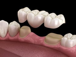 Dental Tooth Supported Bridge