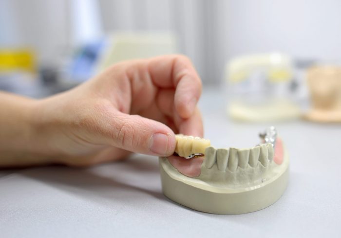 Dental Bridges in Aventura, FL