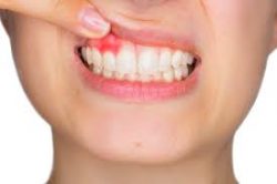 Gingival Recession Treatment in Houston