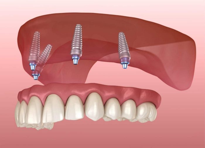 Tooth Implant Surgery in Houston TX