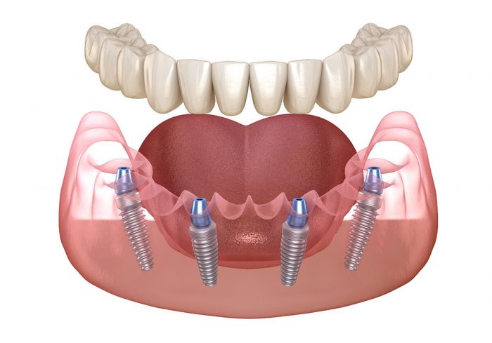 Full Mouth Dental Implants in Houston TX