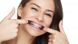 Find Local Orthodontist Near Me For Braces