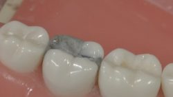 Which Is The Best Dental Filling?