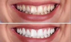 Zoom Teeth Whitening Services Near Me