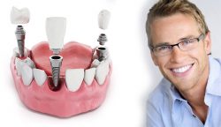 Single Tooth Implants In Houston Heights