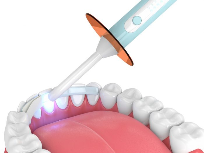 What Are The Benefits Of Teeth Cosmetic Bonding?