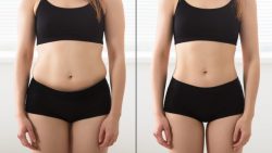 Laser Fat Removal Options, Costs, and Results