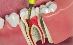 Root Canal Therapy Procedure