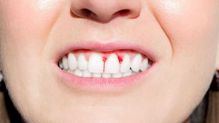 Gum Disease Treatment Near Me