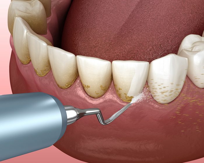 Gingivitis Treatment Near Me