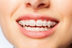 How Do Orthodontic Braces Work?