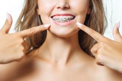 Children’s Orthodontic Braces In Miami Fl