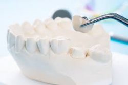 What Is There To Know About Dental Crowns?