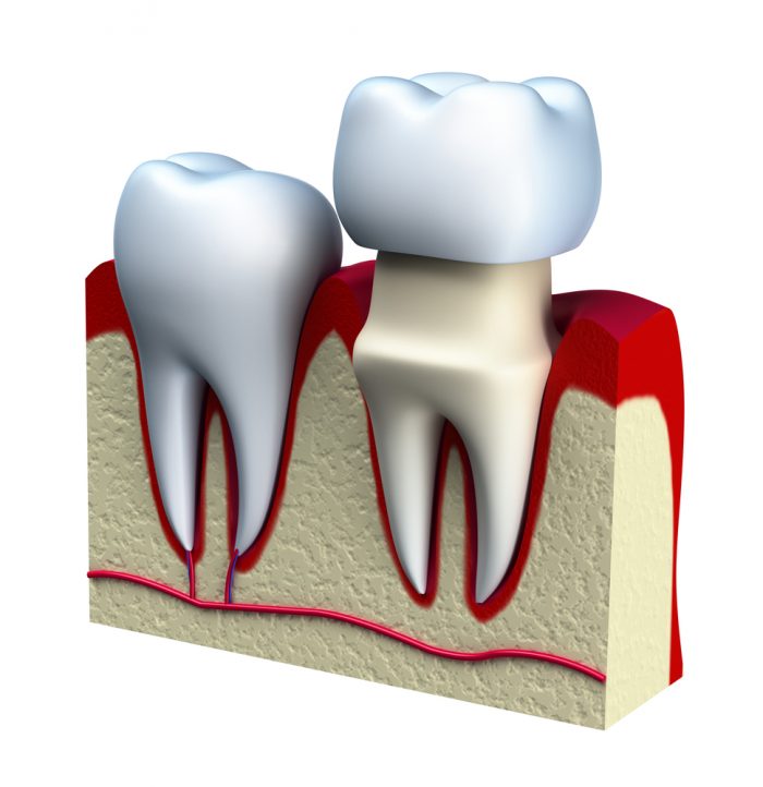 What Is There To Know About Dental Crowns?