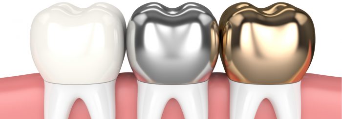 What Are The Different Types Of Dental Crowns?