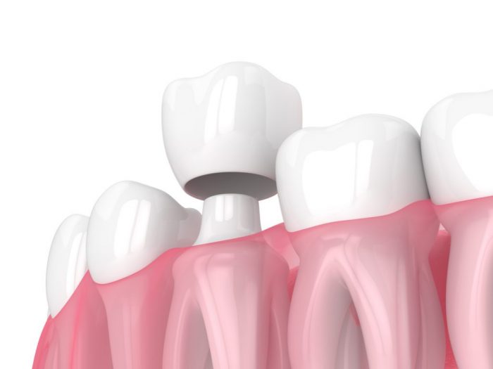 What Is The Procedure Associated With Getting A Tooth Crown?