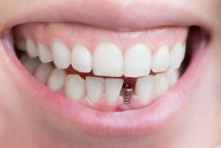 Missing Tooth Replacement Options