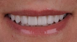 Veneers For Gap Teeth | Fix Front Teeth Gap in Houston, Tx