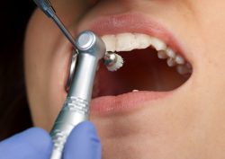 What Are The Benefits Of Teeth Cleaning?