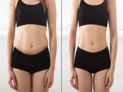 Does laser liposuction really work?