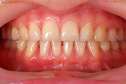 What Causes Swollen Gums? | How To Get Rid Of Swollen Gums?