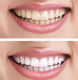What to Expect with Porcelain Veneers: Before and After?