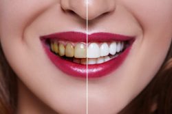 Get Professional Teeth Whitening Near Me to Get Your Smile Back