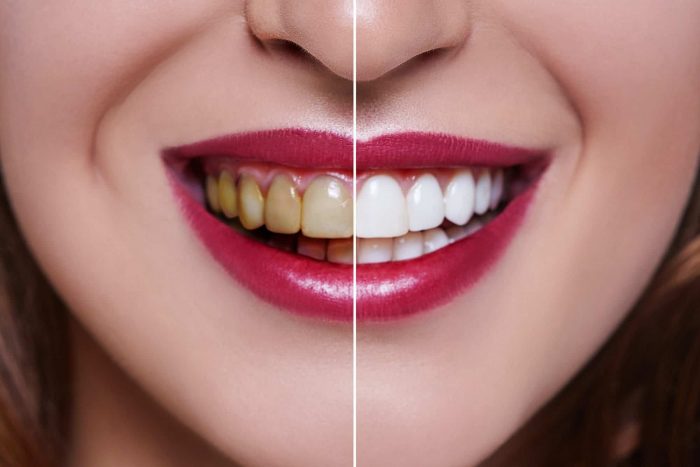 Get Professional Teeth Whitening Near Me to Get Your Smile Back