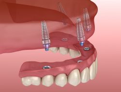Why Choose Affordable Dental Implants Near Me?