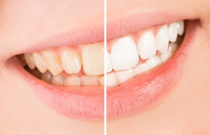 Get Professional Teeth Whitening Near Me to Get Your Smile Back