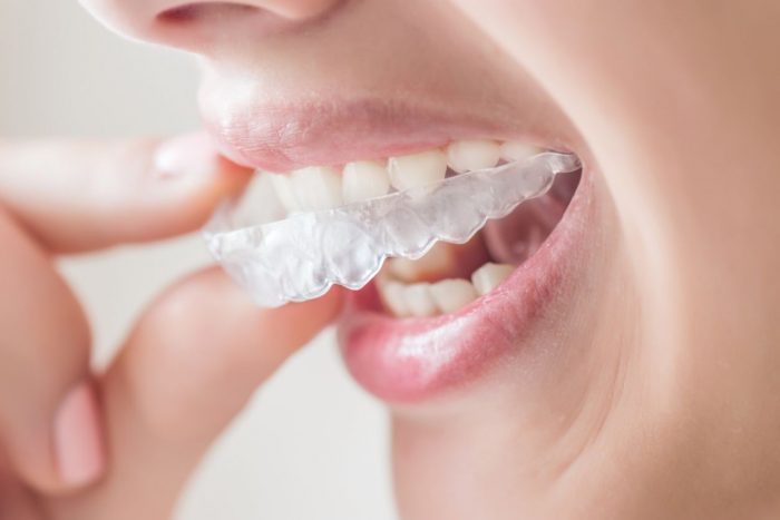 How to Find an Invisalign Dentist Near Me?