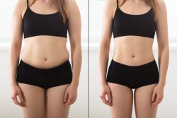 Does laser liposuction really work?