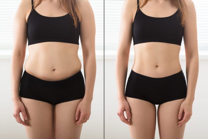 Does laser liposuction really work?