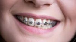 Affordable Dental Braces Near Me