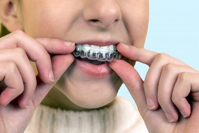 How Much Do Clear Braces Cost?