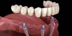 Dental Implants in Surfside, Miami