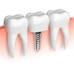 Dental Implants in North Miami