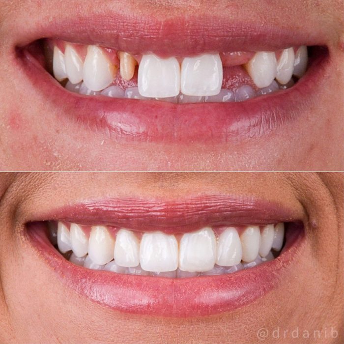 porcelain veneers before and after